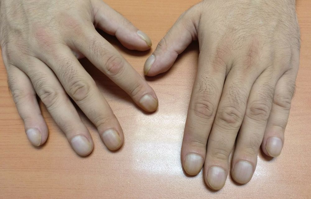 Swelling of the fingertips, known as “clubbing” or acropachy.