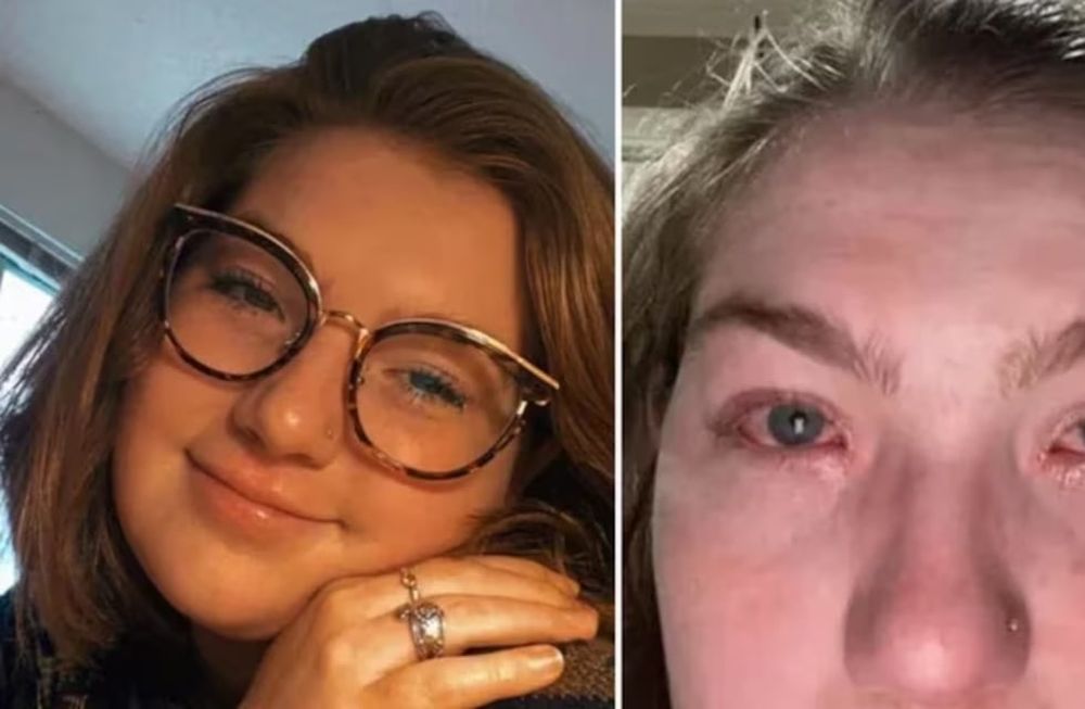 Cuando está junto a su pareja sufre erupciones en la piel, enrojecimiento y ojos llorosos, algo que aún no le encuentran explicación. Gentileza: Infobae.
