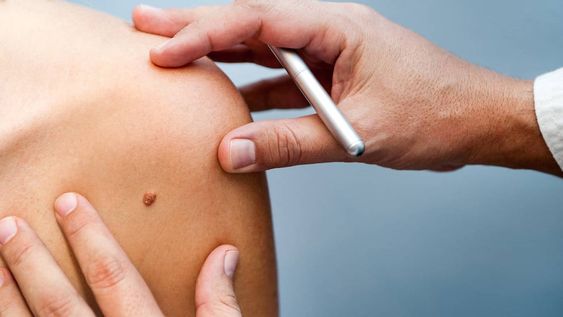 Melanoma, el cáncer de piel más agresivo