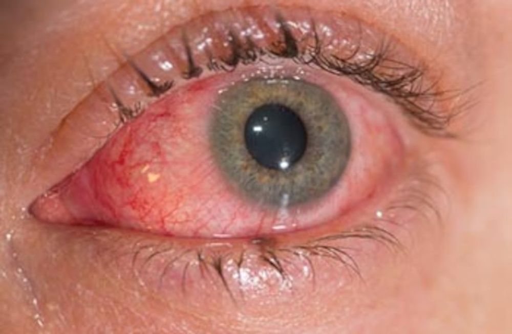 La conjuntivitis puede ser otro síntoma de COVID-19
