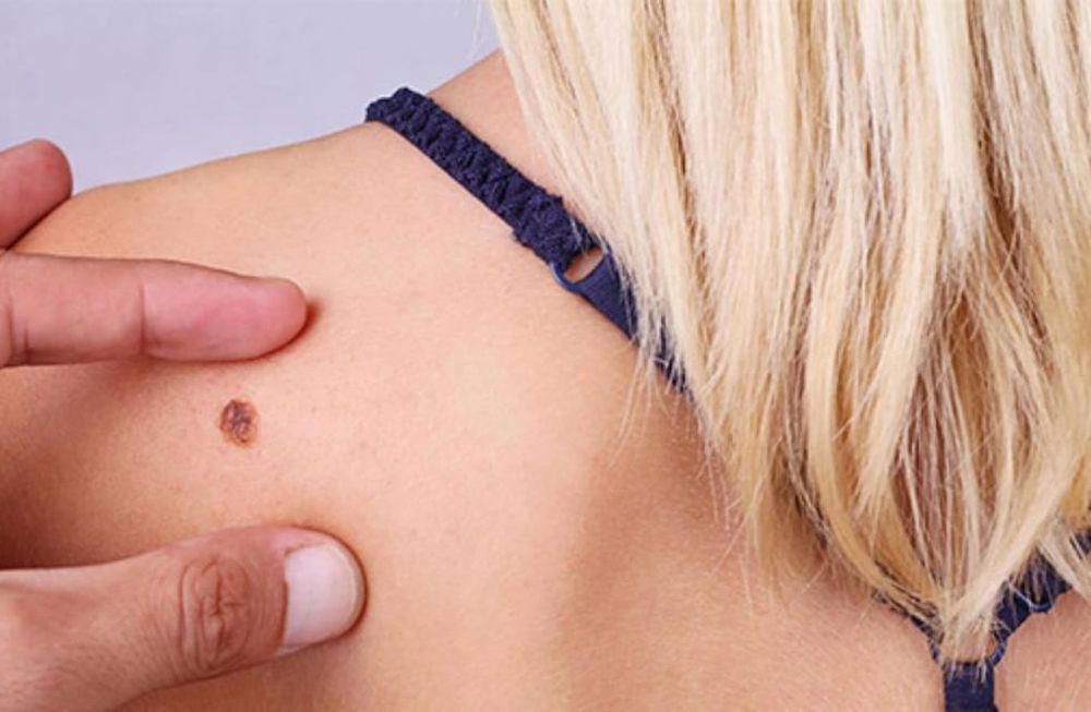 Claves con el sol: cómo prevenir el cáncer de piel