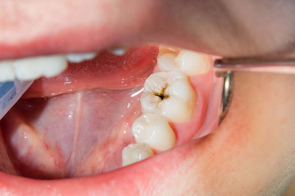 Caries-en-adultos