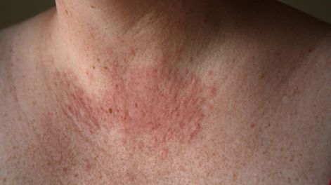 Pueden verse afectados todos los tipos de piel y no siempre se conoce la causa exacta. Imagen ilustrativa / Web