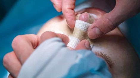 Un hombre se operó su nariz en su propia casa a través de un tutorial. Lo internaron de urgencia en un hospital.