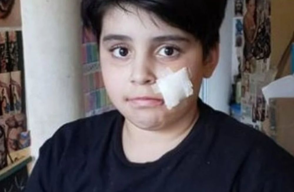 Lautaro de 10 años fue a saludar a un amigo y su perro le mordió la cara. / Foto: Gentileza