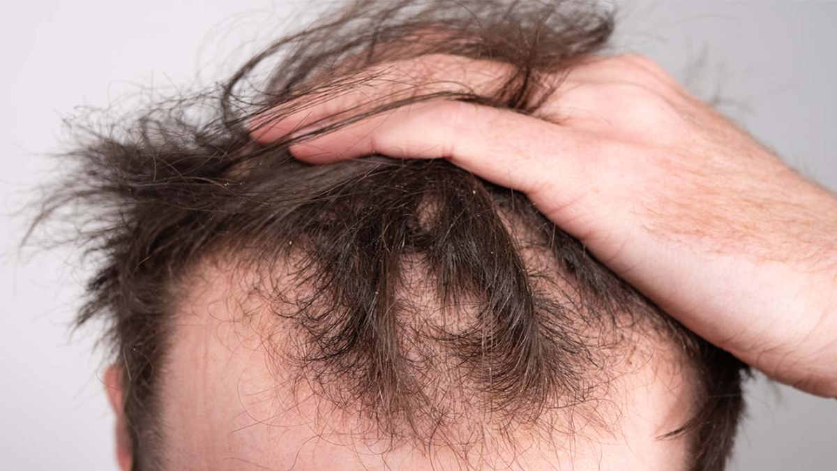 Chau a la calvicie: el azúcar natural que hace crecer el cabello y sorprende a la ciencia