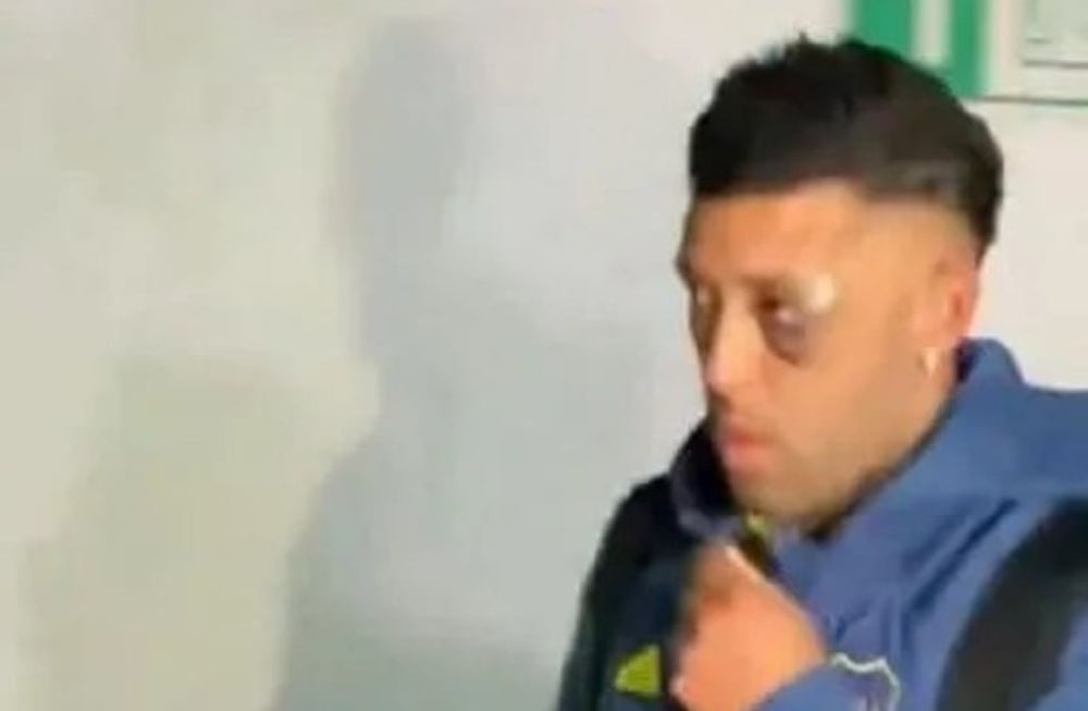 El ojo lastimado de Janson, jugador de Boca Juniors. / Gentileza.