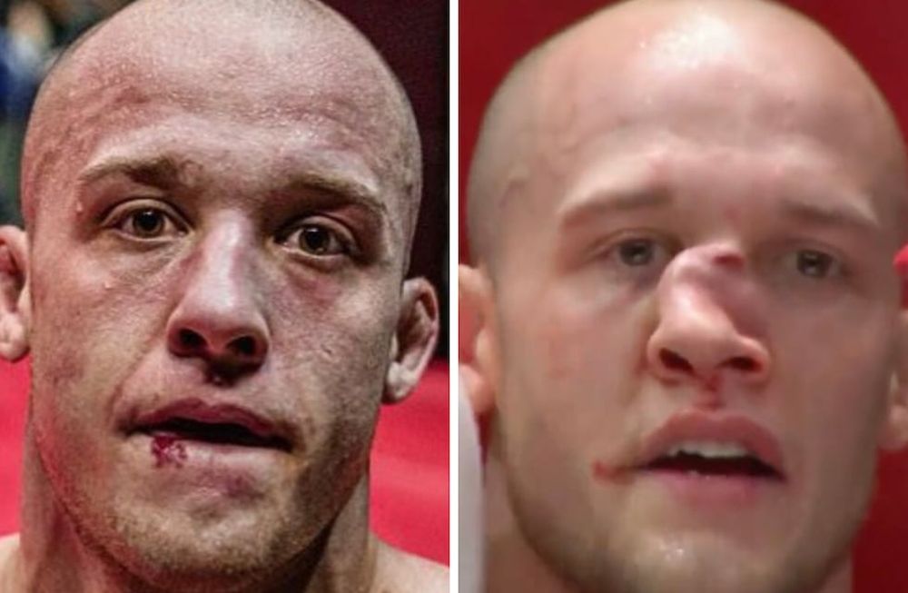 El luchador Blake Perry quedó con su rostro desfigurado por un rodillazo en la cara.
