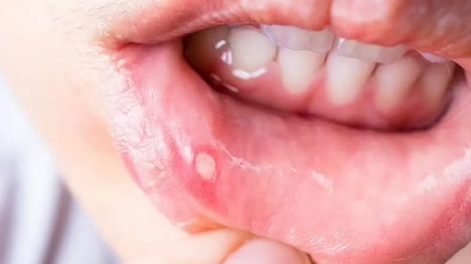 Alarma por la sífilis: aumentas los casos en 2025.