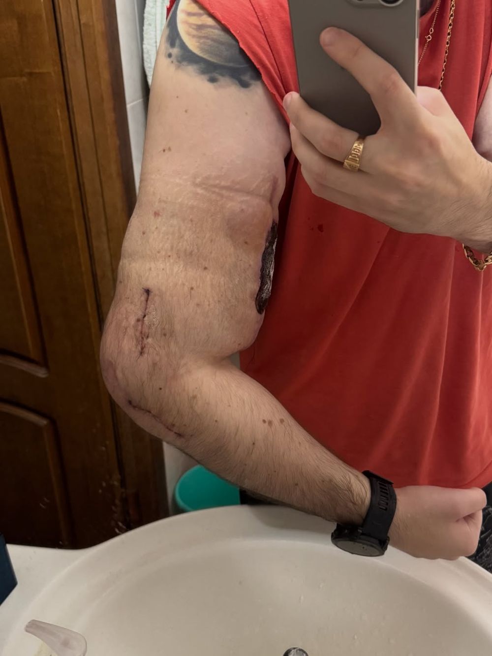 A los 29 años, el influencer enfrenta nuevas intervenciones y la posibilidad real de amputación, en un caso extremo de los peligros de la búsqueda de fama viral.