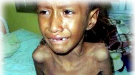 La desnutrición entre los niños de comunidades originarias