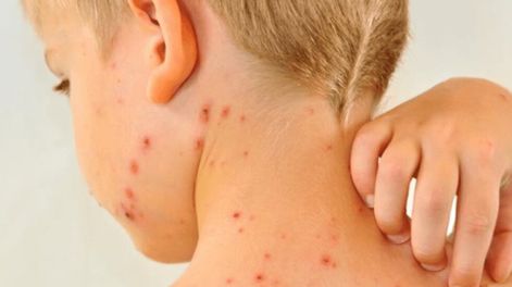 Pérdida del estatus de eliminación del sarampión en las Américas (Foto ilustrativa)