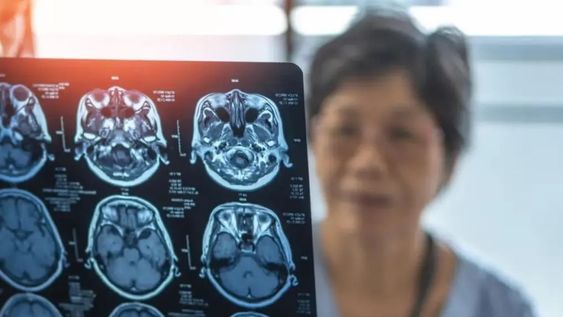 Los científicos creen ampliamente que, en los cerebros de los pacientes con Alzheimer, fragmentos de esta proteína se acumulan lentamente y forman cúmulos.