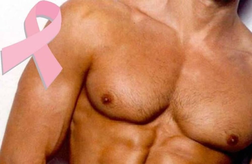 El c&aacute;ncer de mama tambi&eacute;n puede afectar a los varones
