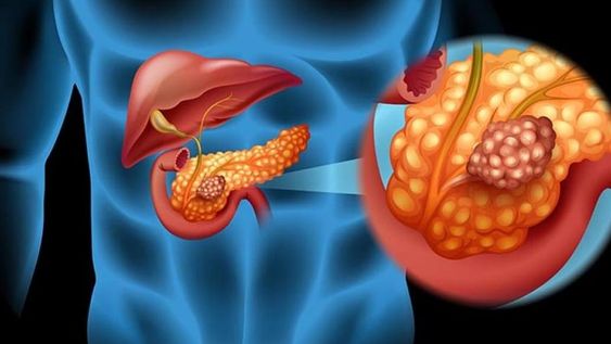 ¿Cómo podemos prevenir el cáncer de páncreas?