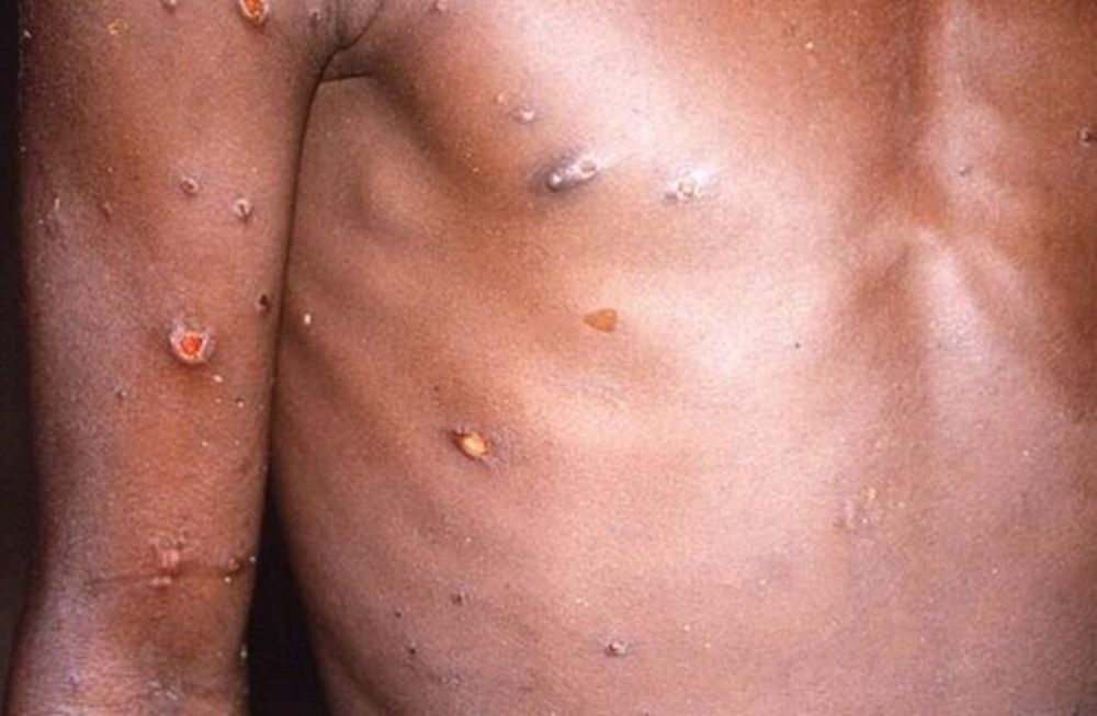 Bélgica es el primer país europeo en imponer cuarentena a los pacientes con diagnósitco confirmado. Foto: BBC.