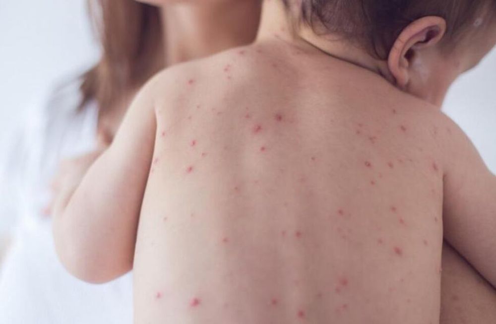 El sarampión en la mira: vacunación y vigilancia epidemiológica son las estrategias mendocinas