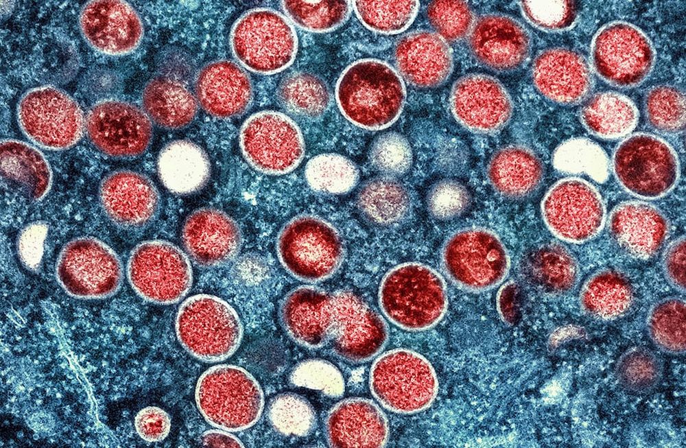 La Organización Mundial de la Salud declaró recientemente que el brote de viruela del simio en expansión es una emergencia mundial. (AP)