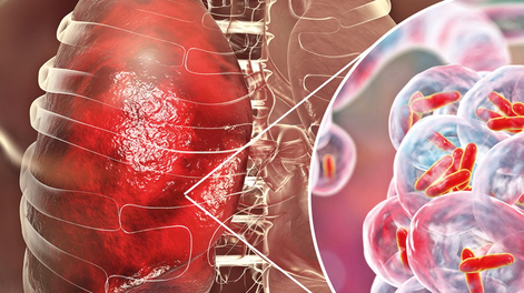 Tuberculosis