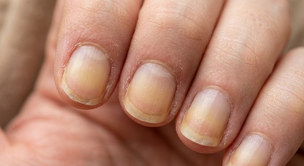 uñas amarillas