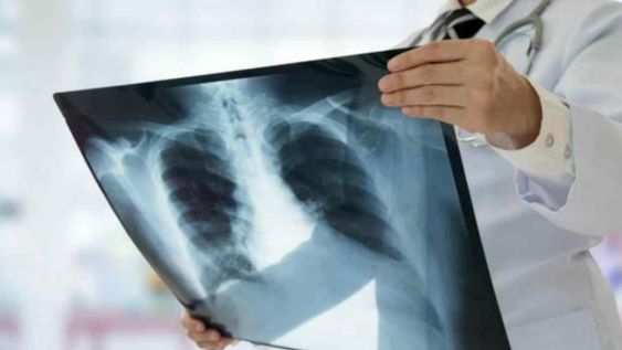 Tuberculosis. A pesar de los avances en diagnóstico y tratamiento, esta antigua enfermedad sigue siendo un grave problema de Salud Pública a nivel mundial. (AP)