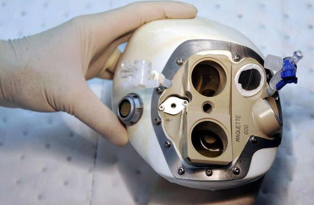 Un corazón artificial autónomo fue implantado en Francia