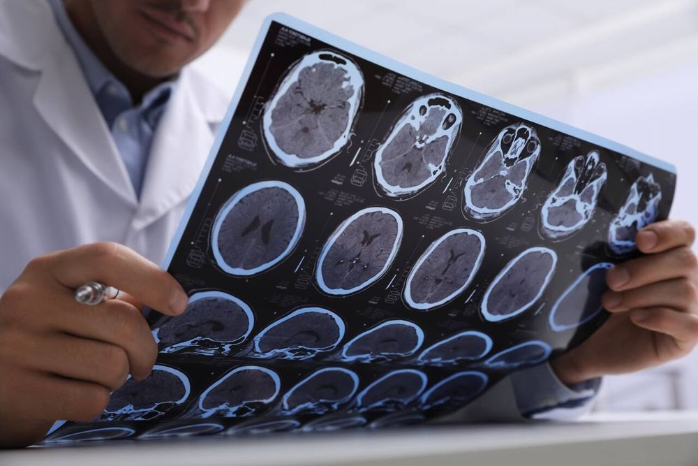 Investigaci&oacute;n sobre el Alzheimer: podr&iacute;a ayudar a explicar por qu&eacute; se manifiesta y progresa de manera diferente de una persona a otra y la posibilidad de revertir los da&ntilde;os que produce esta patolog&iacute;a.