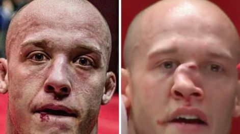 El luchador Blake Perry quedó con su rostro desfigurado por un rodillazo en la cara.