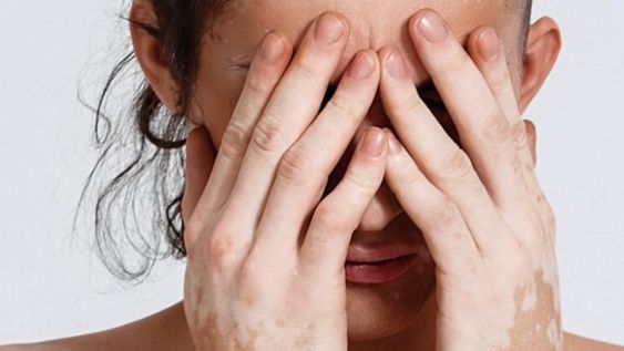 Vitiligo, más que solo manchas