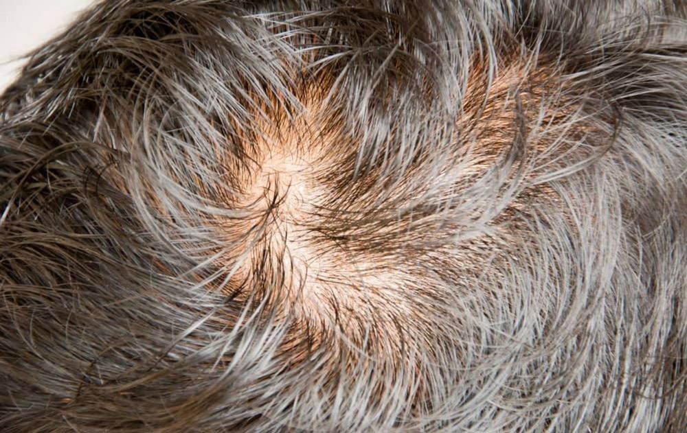 No existe un truco definitivo pero hay diferentes formas de anticiparse a la caída constante del pelo.