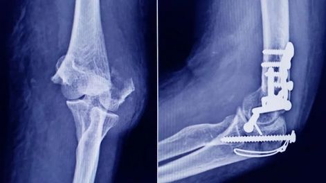 ANMAT alertó sobre el uso de un tornillo falsificado utilizado en cirugías traumatológicas.