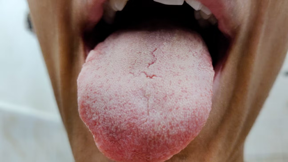que significa tener la lengua blanca, segun la ciencia