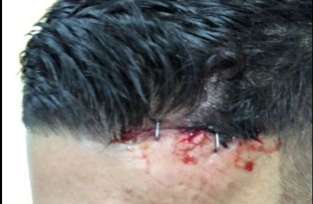 Marcos Rojo se rompió la cabeza y le cerraron la herida con una engrapadora