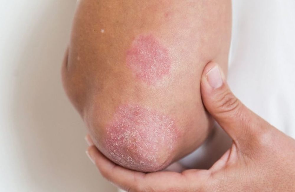 29 de octubre, Día Mundial de la Psoriasis