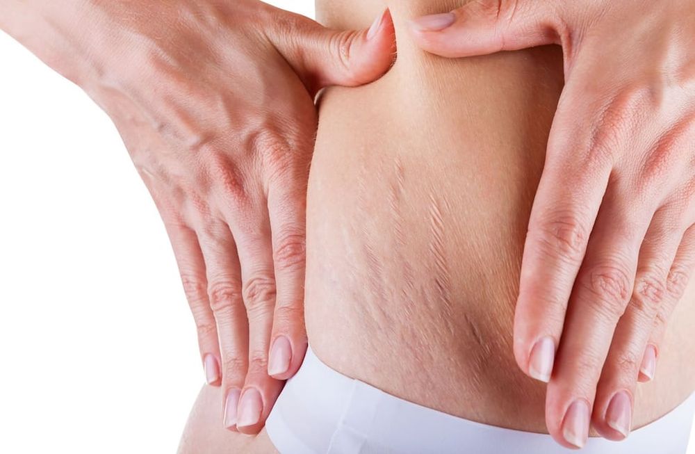 Síndrome de Cushing: signos y síntomas del aumento de cortisol en el cuerpo