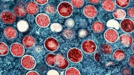 Los Andes | Virus. Se secuenciaron varias muestras de viruela del mono para determinar el origen del brote. (Instituto de Enfermedades Infecciosas y Alergias de EE.UU.)