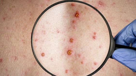 La viruela símica (mpox) es una enfermedad vírica causada por el virus de la mpox, que pertenece al género de los Orthopoxvirus, tal cual describe la Organización Mundial de la Salud (OMS).