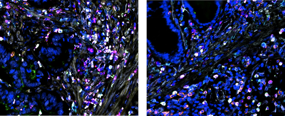 Microscopía de fluorescencia donde se muestras las celdas tumorales en azul, y las células del sistema inmune en colores. En rosa son las células mieloides y las blancas las células T del sistema inmune que están trabajando para el tumor ( Treg).  