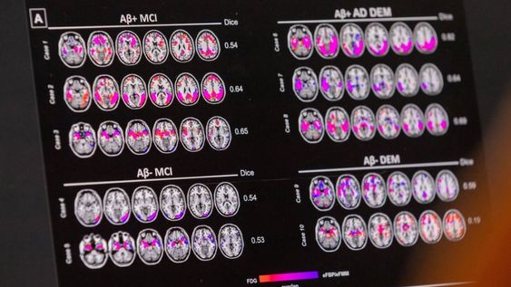 Los escáneres cerebrales pueden detectar niveles anormales de una proteína llamada beta amiloide. Gentileza: Noticias Argentinas.