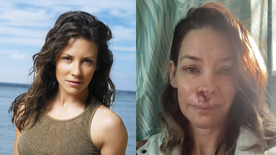 El accidente que le provocó daño cerebral crónico a la actriz Evangeline Lilly