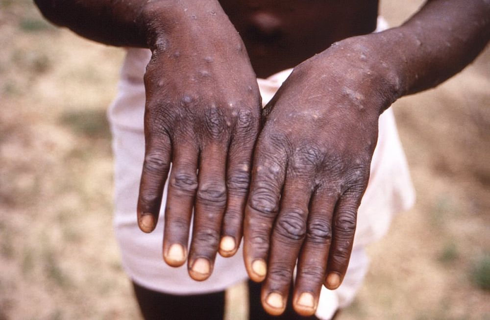 La viruela símica, o mpox, es una patología endémica de los países de África central y occidental, pero desde el 14 de agosto, se ha transformado en emergencia de salud pública de importancia internacional (CDC vía AP, Archivo)