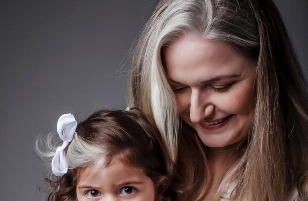 La pequeña nació con piebaldismo, una condición genética que hace que las áreas de la piel o el cabello parezcan más claras de lo habitual.