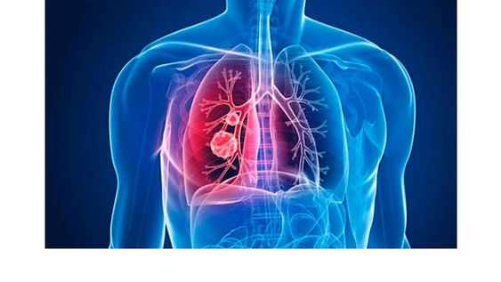 Hipertensión pulmonar: dentro de las 7.000 enfermedades raras en el mundo