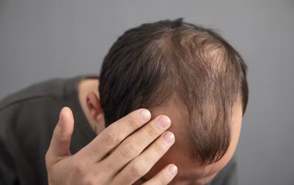No existe un truco definitivo pero hay diferentes formas de anticiparse a la caída constante del pelo.