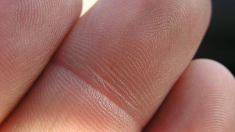 El extraño cambio en los dedos que puede alertar sobre uno de los cánceres más mortales: el de pulmón