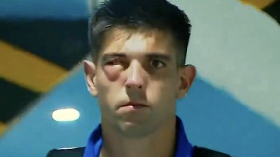 Facundo Altamirano sufrió ayer una fractura en el rostro, tras un choque en el área con su compañero Gastón Hernández, en la caída contra Racing por 4 a 1. / Gentileza.