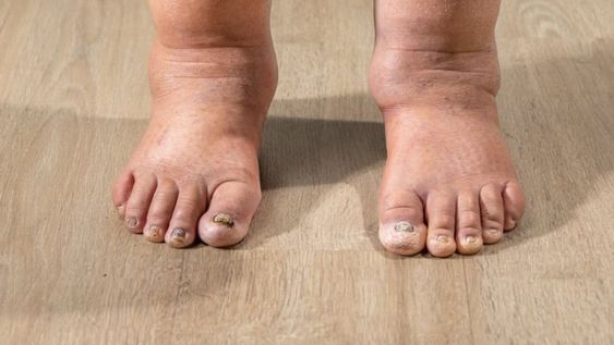 La causa principal puede venir de distintos hábitos diarios que solo perjudican el cuerpo.
