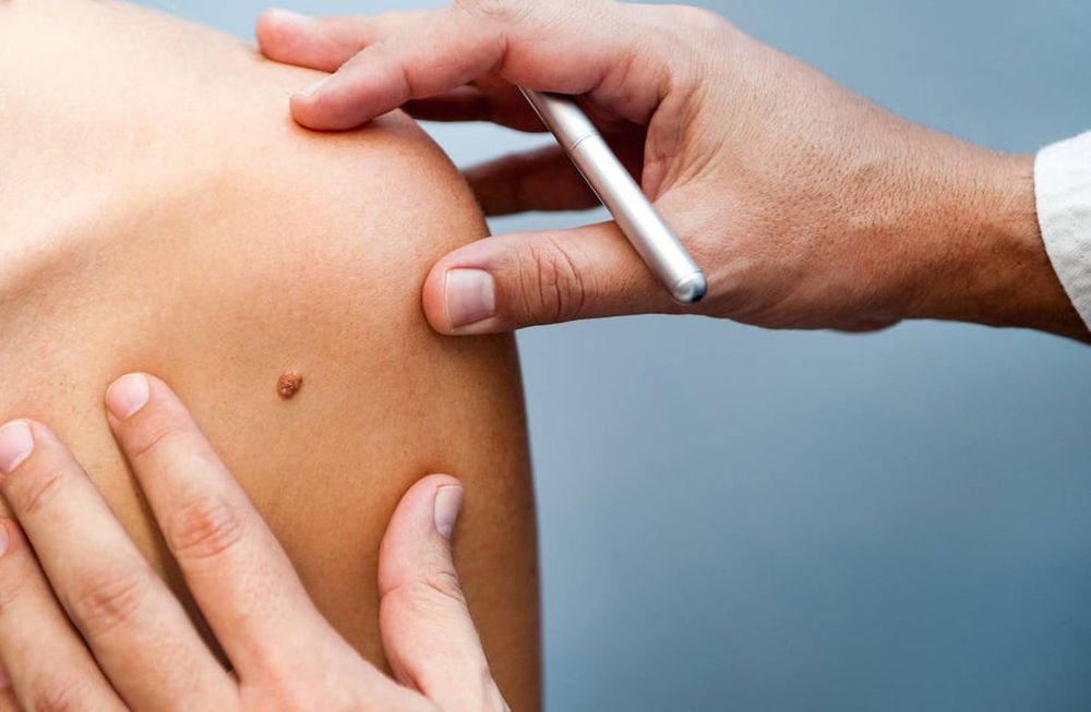 23 de mayo, Día Mundial del Melanoma