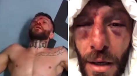Así quedó el rostro del luchador argentino tras el combate contra el canadiense.