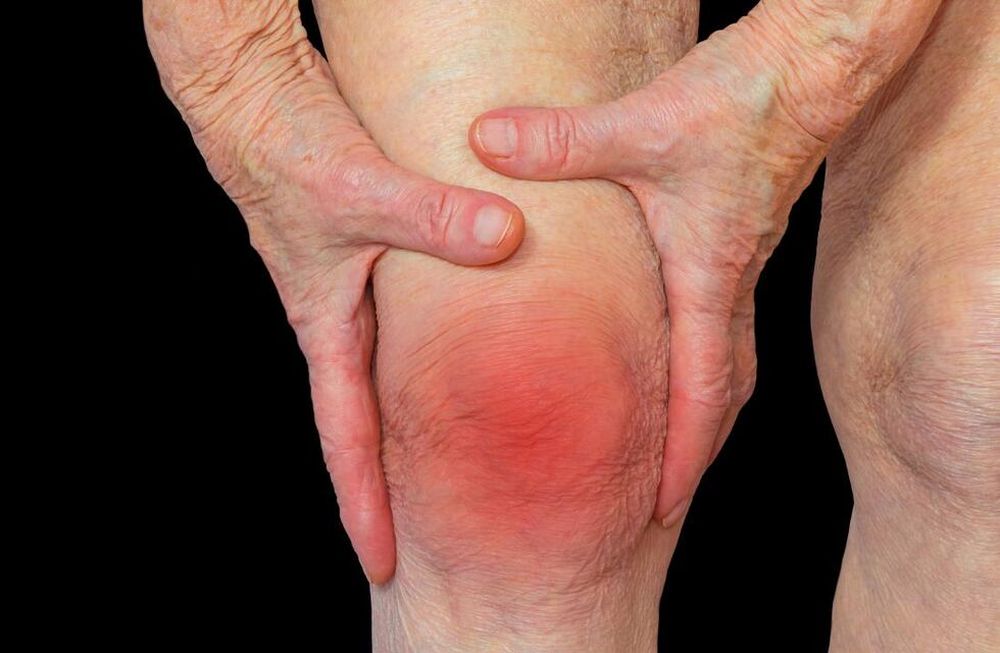 Artritis reumatoide: enfermedad que afecta entre 1 y 1,5% de la población mundial